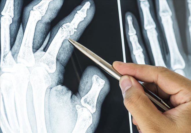 Bone Fractures First Aid for Accident Victims