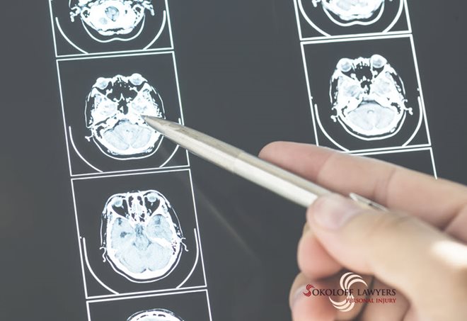 Brain Damaged Injuries Lawyers Can Help You Get Compensation braindamageinjurieslawyer