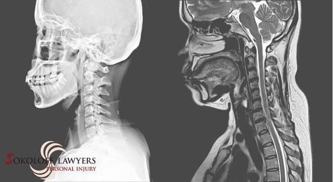 Spinal Cord Injuries Lawyers Help Accident Victims spinalcordinjurieslawyer