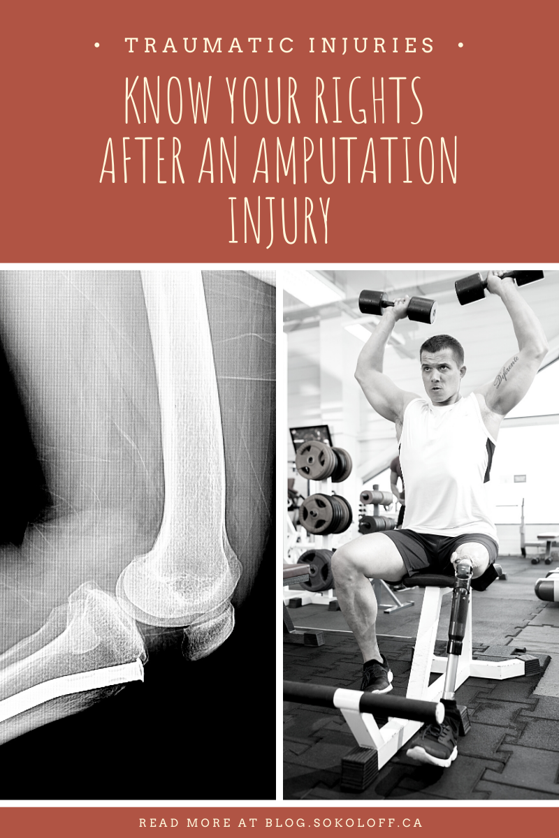 What are My Rights After an Amputation Injury