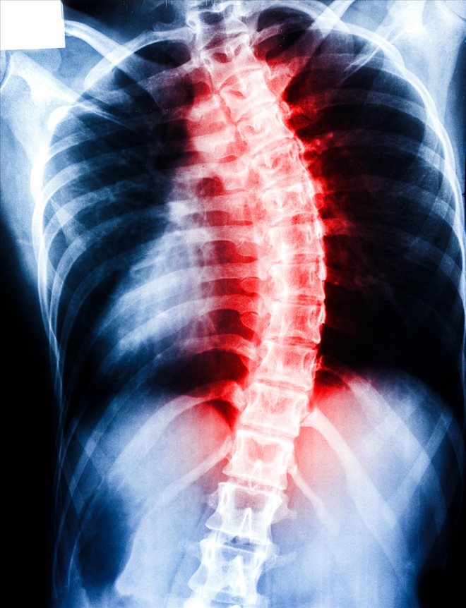 Filing a Spinal Injury Claim with the Help of a Toronto Personal Injury Lawyer