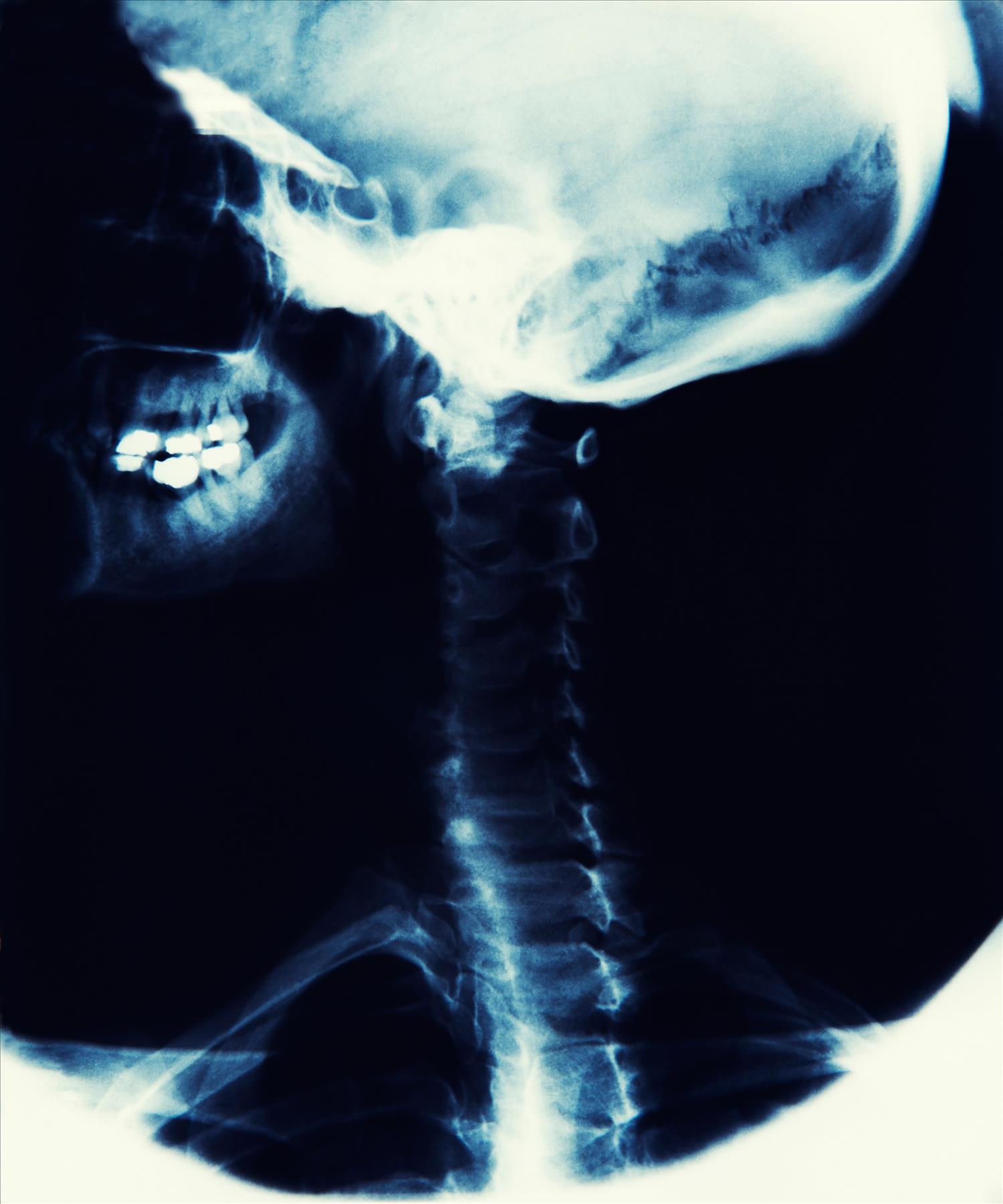 Understanding your Neck Injury Claim