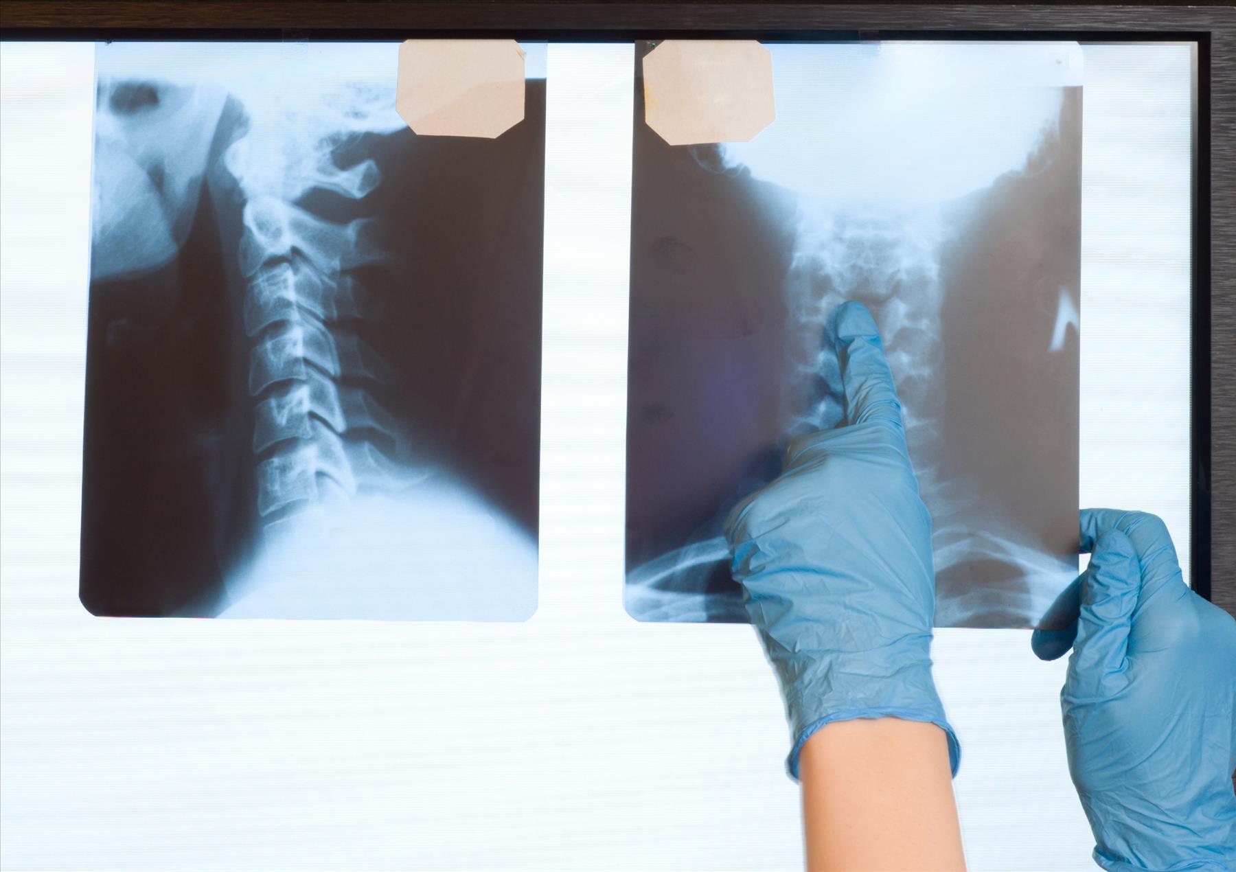 Finding a Neck Injury Lawyer after Experiencing Whiplash in a Crash