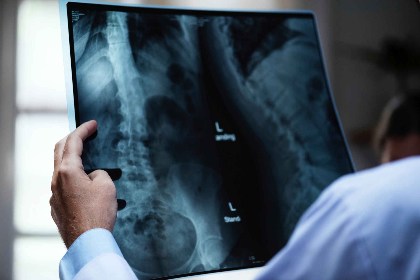 Spinal Cord Injuries and Personal Injury Cases
