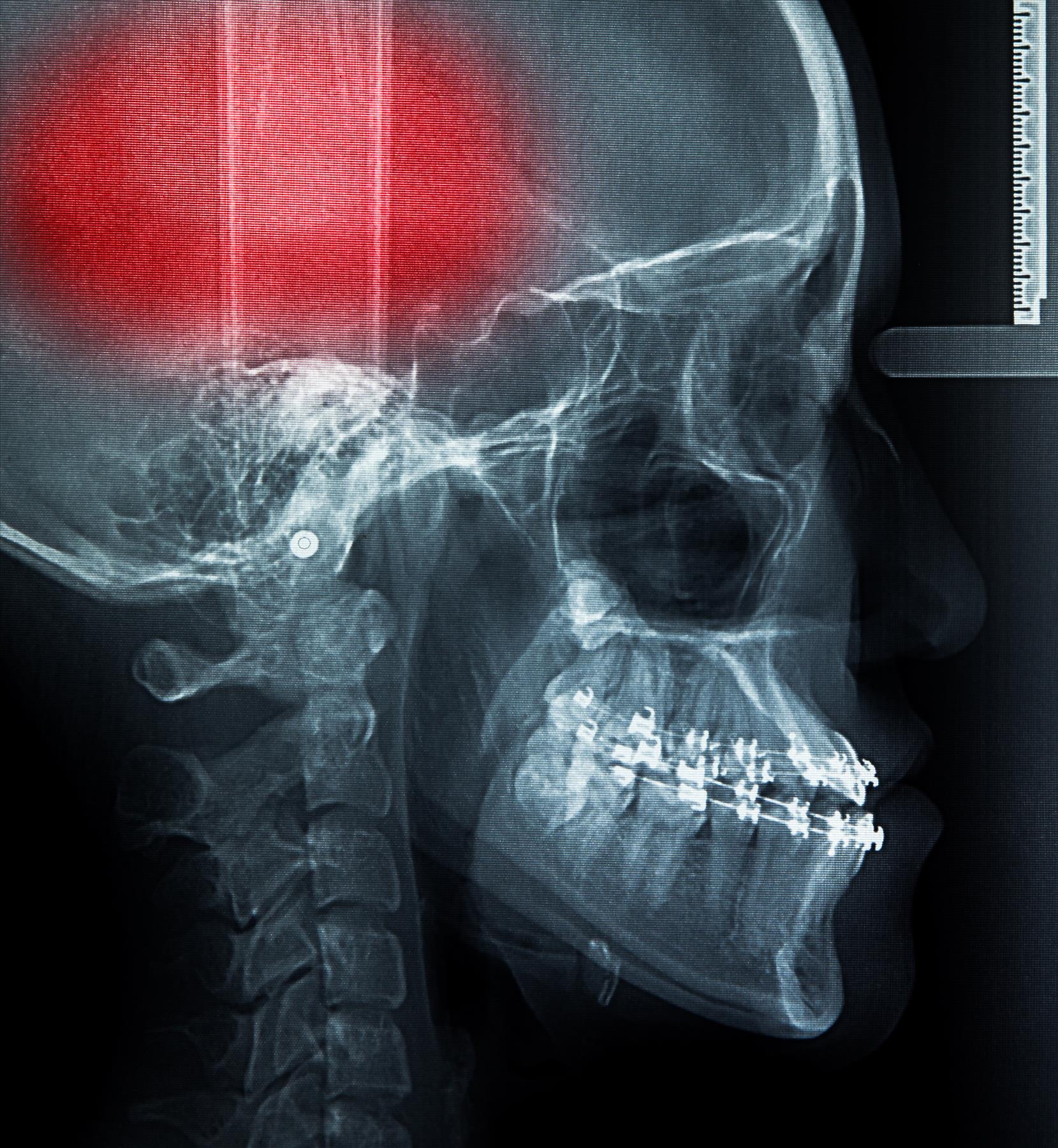 What is the Law if I Sustained a Brain Injury?